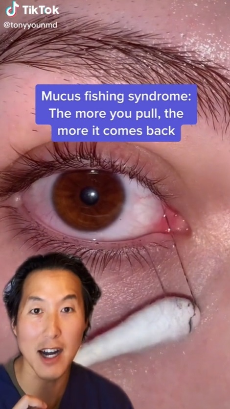 ขี้ตาเป็นเส้น