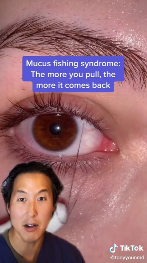 ขี้ตาเป็นเส้น