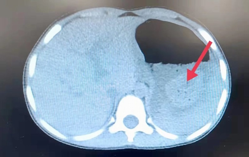 โคล่ารักษานิ่ว