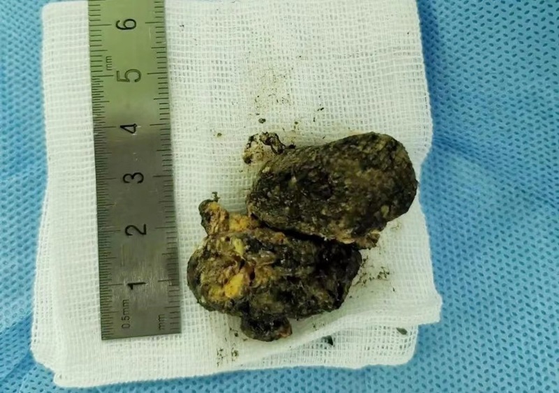 โคล่ารักษานิ่ว