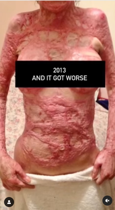 สาวโดนเผาร่าง