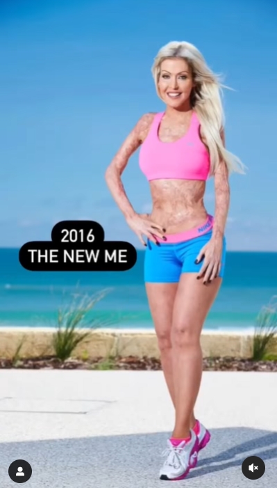 สาวโดนเผาร่าง