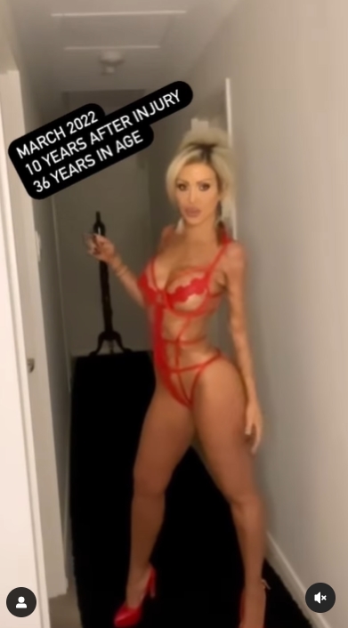 สาวโดนเผาร่าง