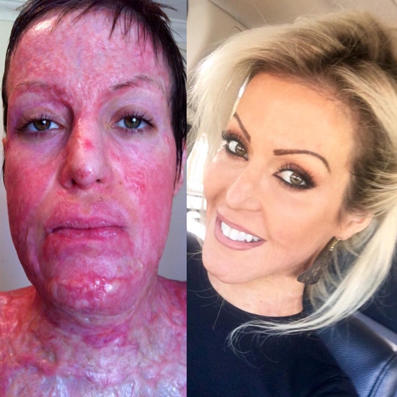 สาวโดนเผาร่าง