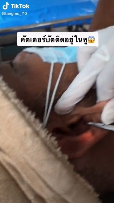 คอตตอนบัดติดหู