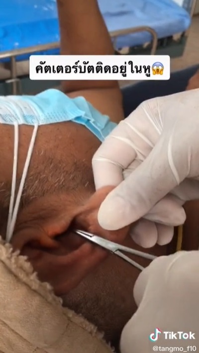 คอตตอนบัดติดหู