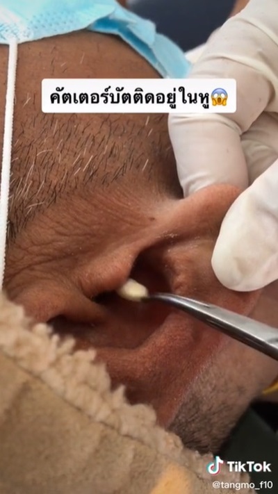 คอตตอนบัดติดหู