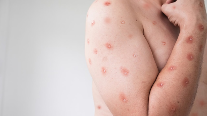 ฝีดาษลิง