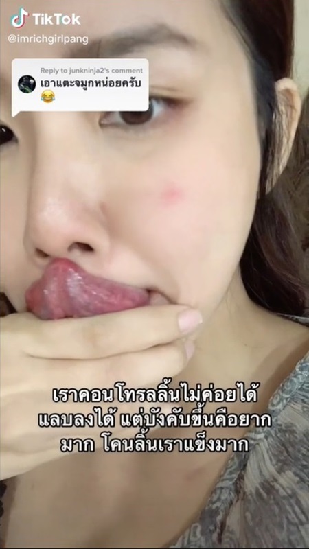 แชร์ประสบการณ์ลิ้นขาด