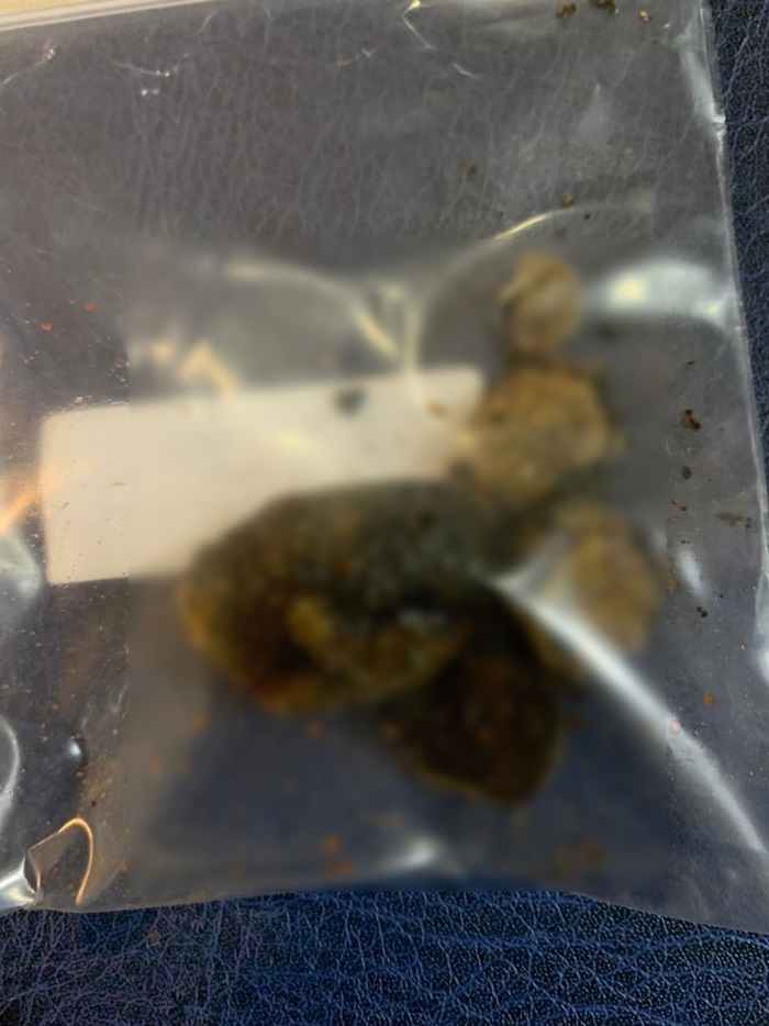 ถุงน้ำดีเน่า