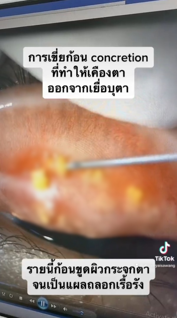 หินปูนในตา