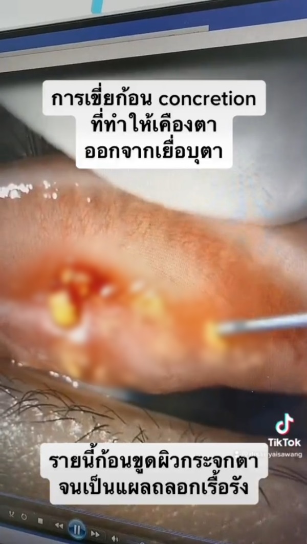 หินปูนในตา