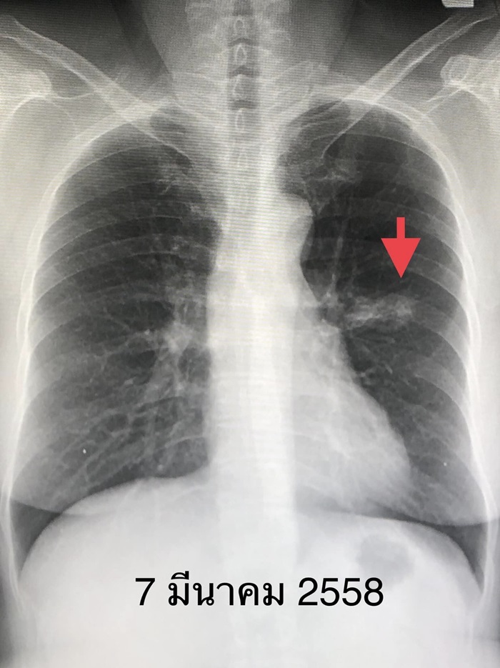 มะเร็งปอด