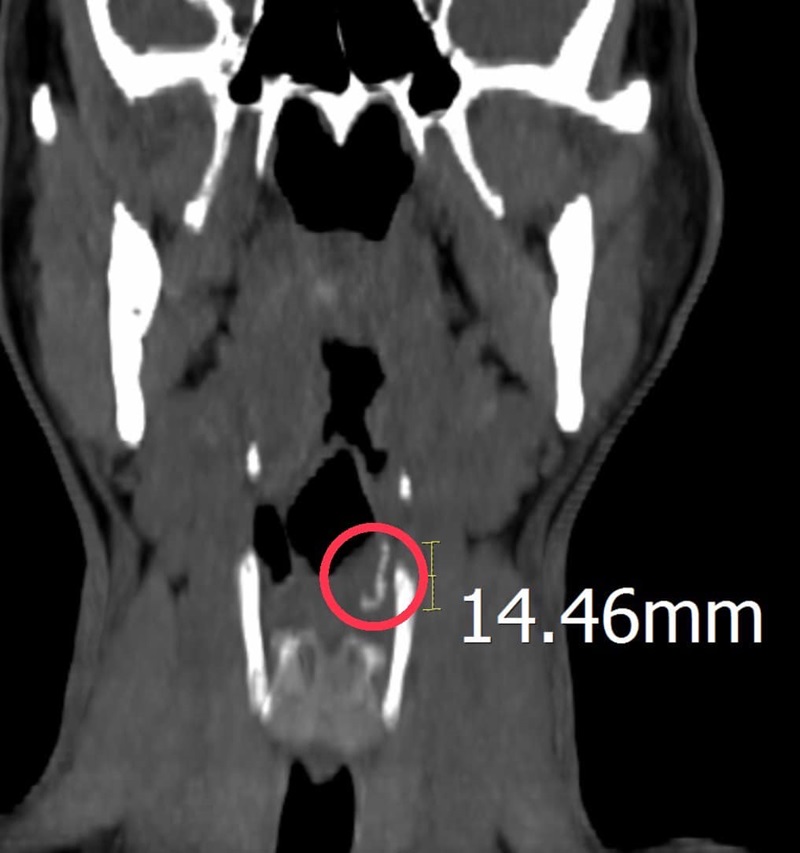 ฝอยขัดหม้อติดคอ
