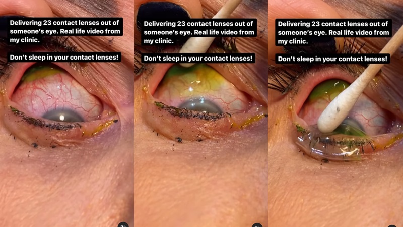 ลืมถอดคอนแทคเลนส์