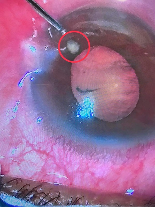 หินเข้าตา