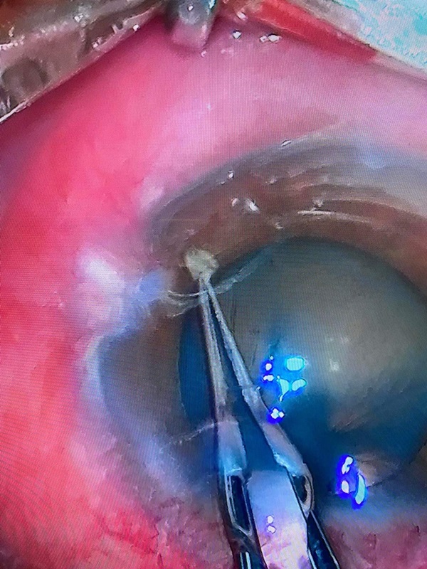 หินเข้าตา