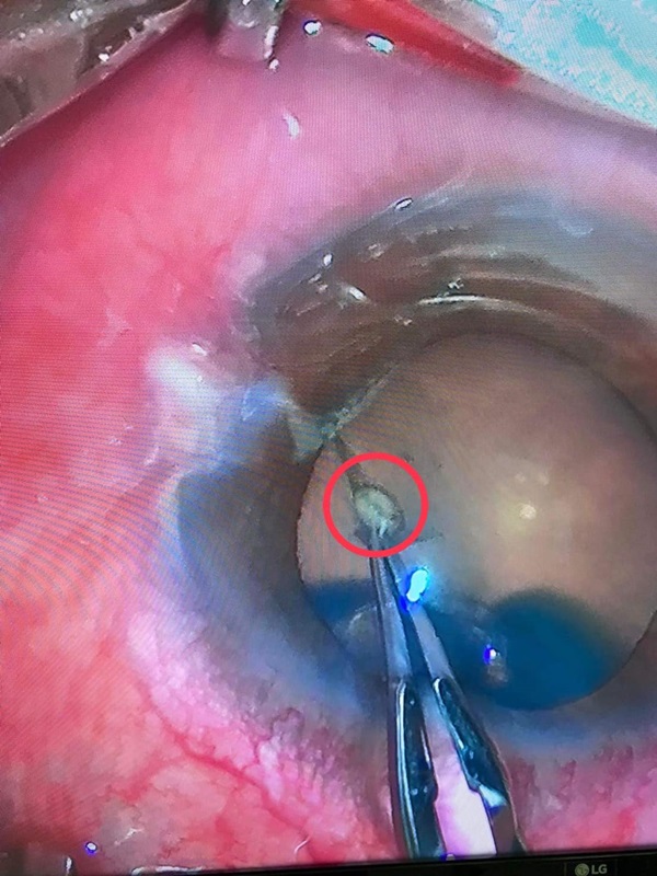 หินเข้าตา