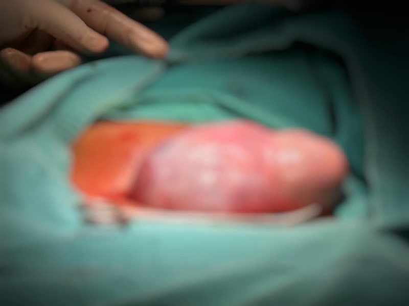 เดอร์มอยด์ซีสต์