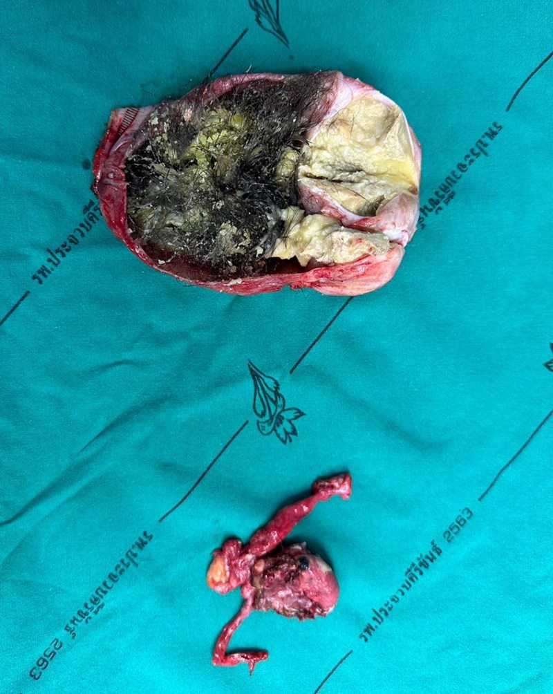 เดอร์มอยด์ซีสต์