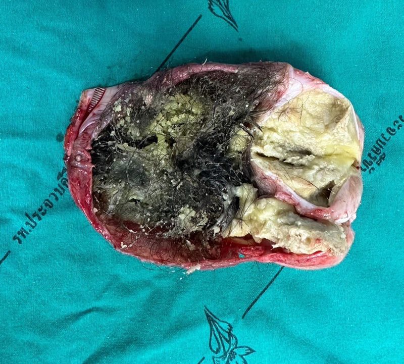 เดอร์มอยด์ซีสต์