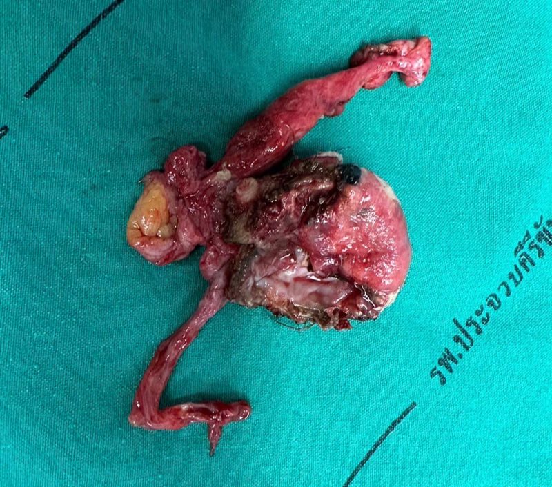 เดอร์มอยด์ซีสต์