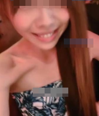 สำลักอาหารจนซี่โครงหัก