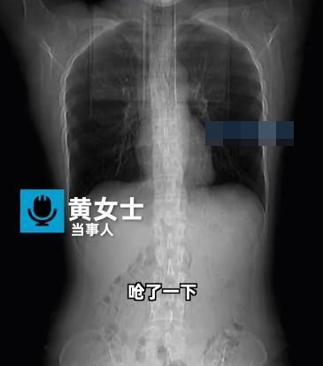 สำลักอาหารจนซี่โครงหัก