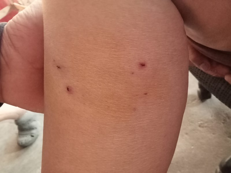 แผลติดเชื้อ