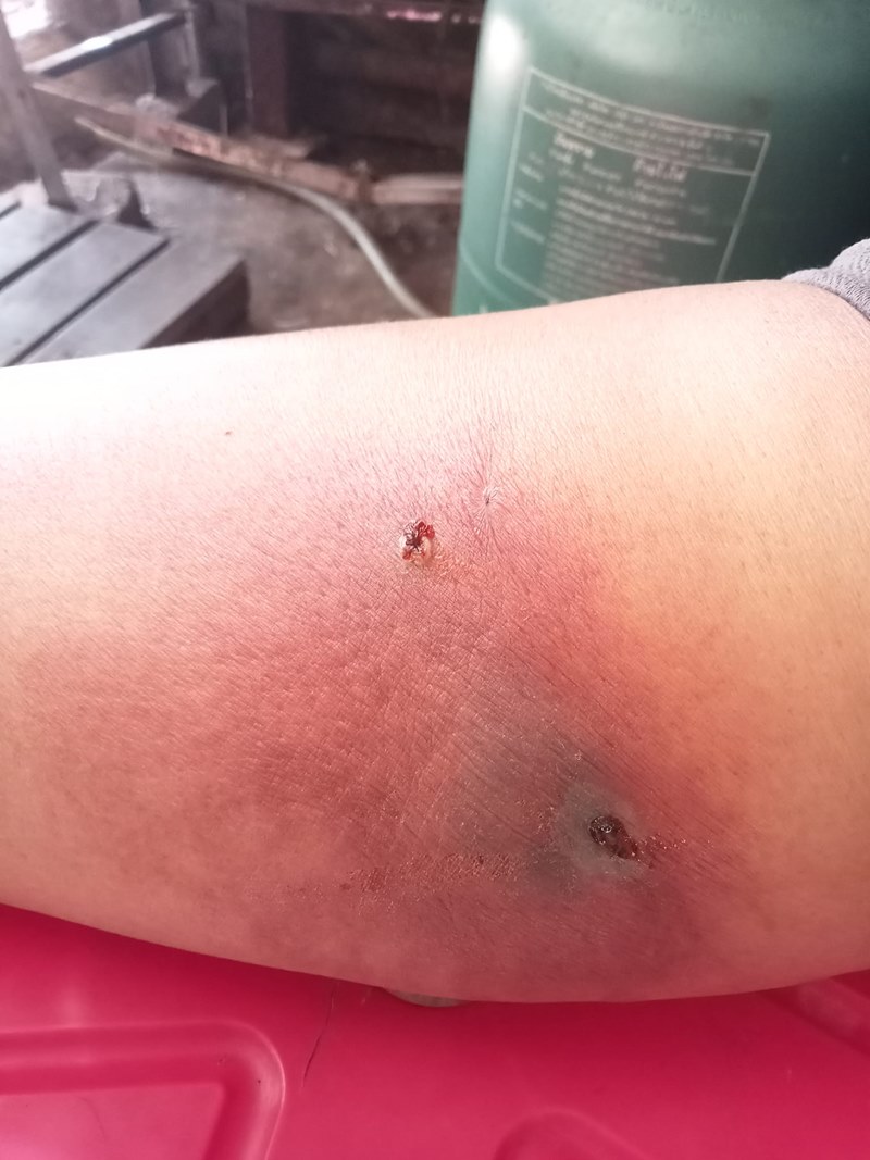 แผลติดเชื้อ