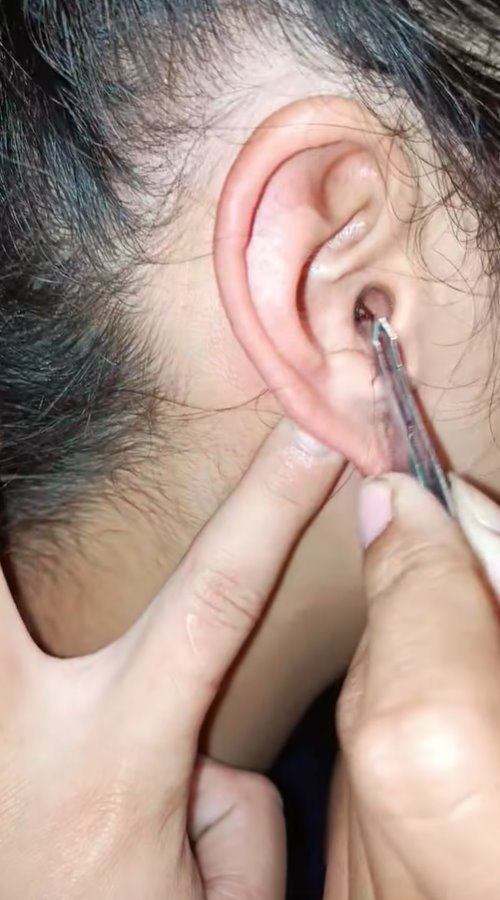 แมลงเข้าหู