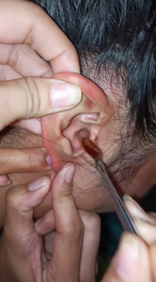 แมลงเข้าหู