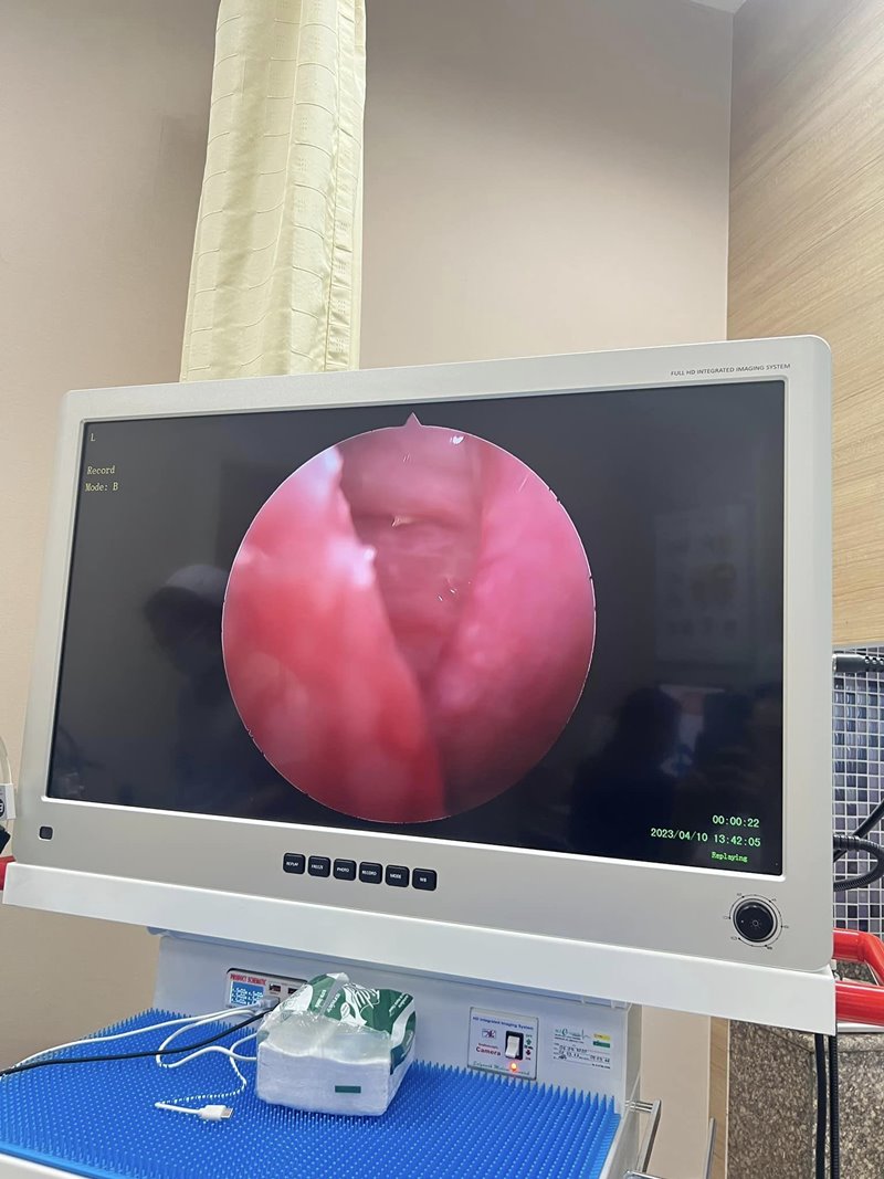 ก้างปลาติดคอ