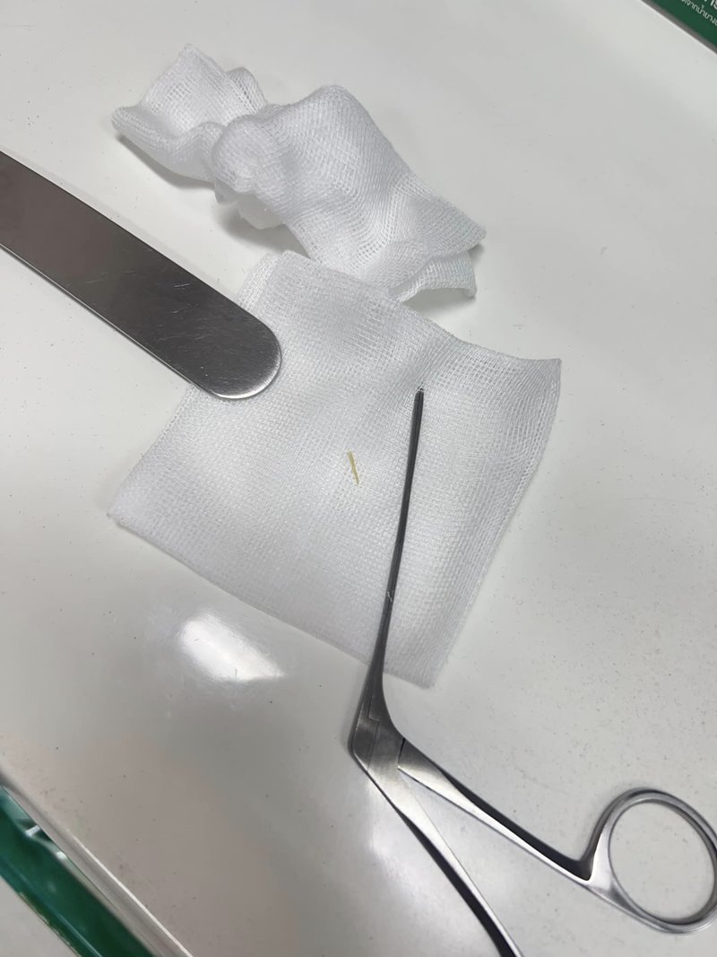 ก้างปลาติดคอ