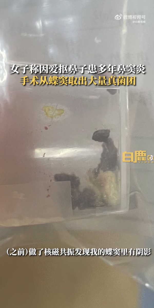 เชื้อราในจมูก