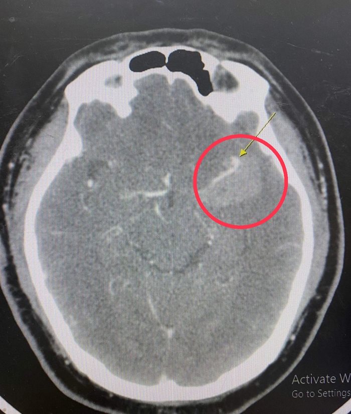 เส้นเลือดในสมองโป่งพอง