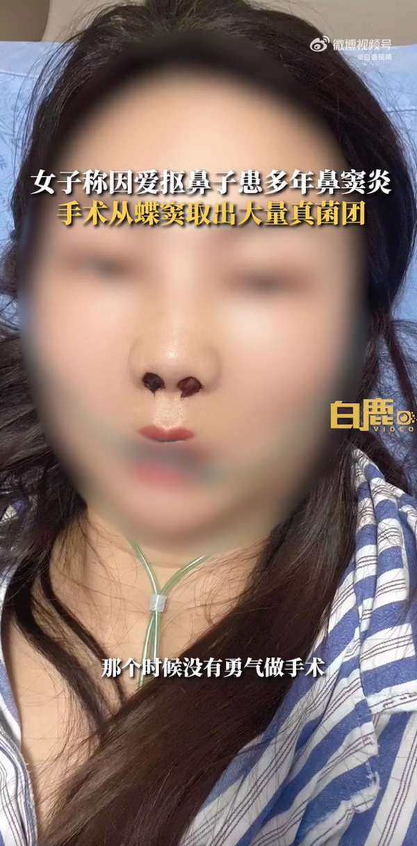 เชื้อราในจมูก