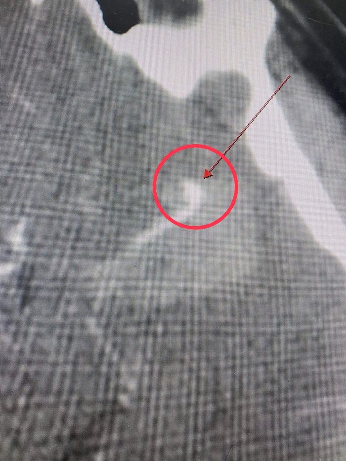 เส้นเลือดในสมองโป่งพอง