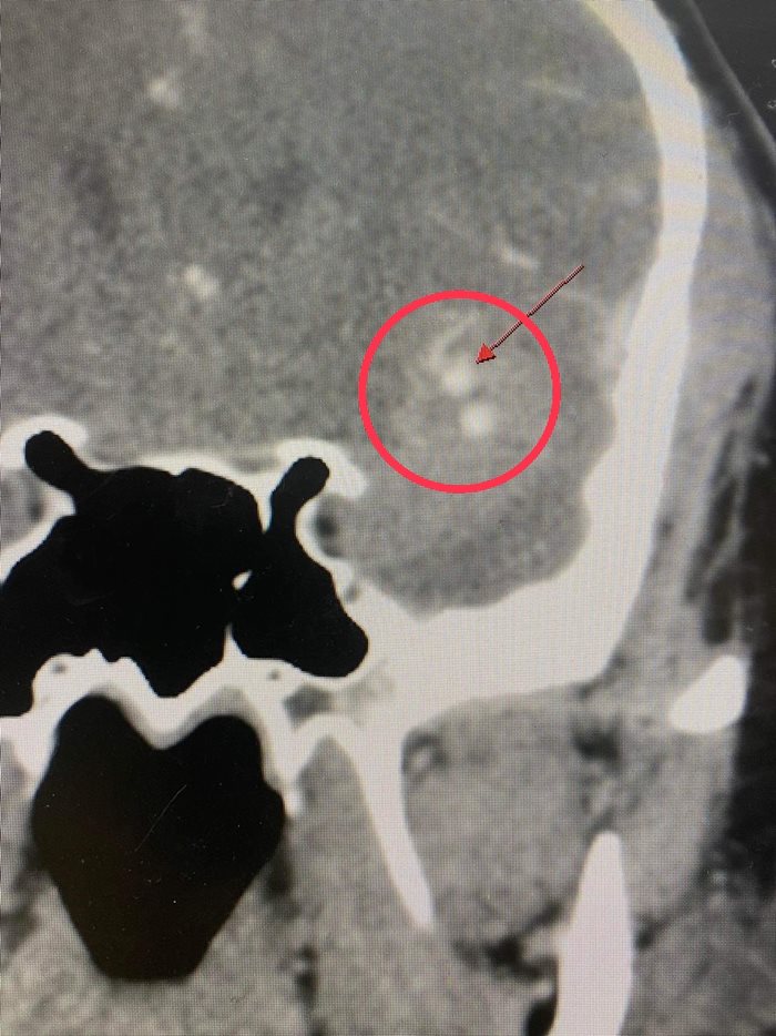 เส้นเลือดในสมองโป่งพอง