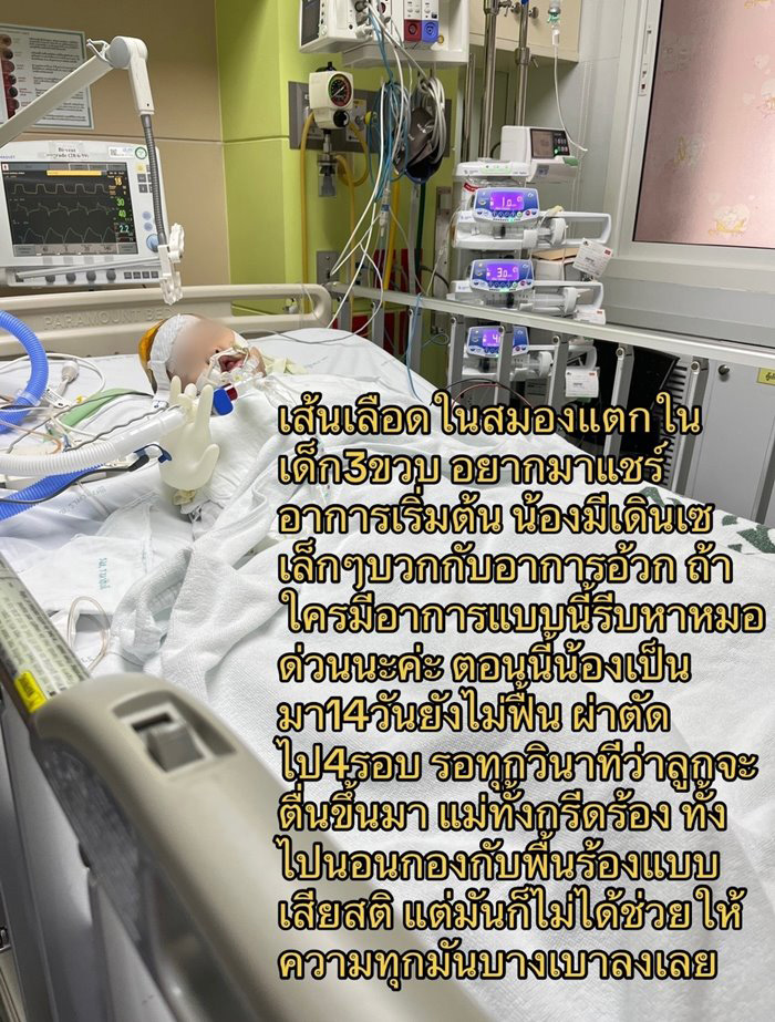 เด็กเส้นเลือดในสมองแตก