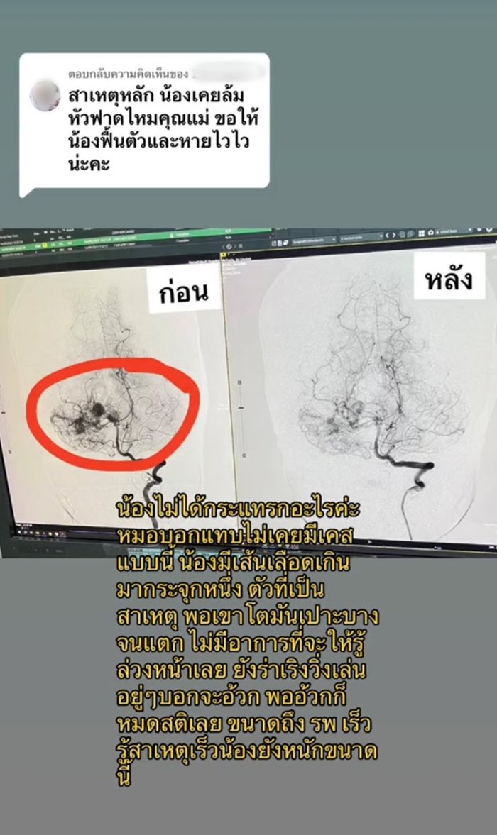 เด็กเส้นเลือดในสมองแตก