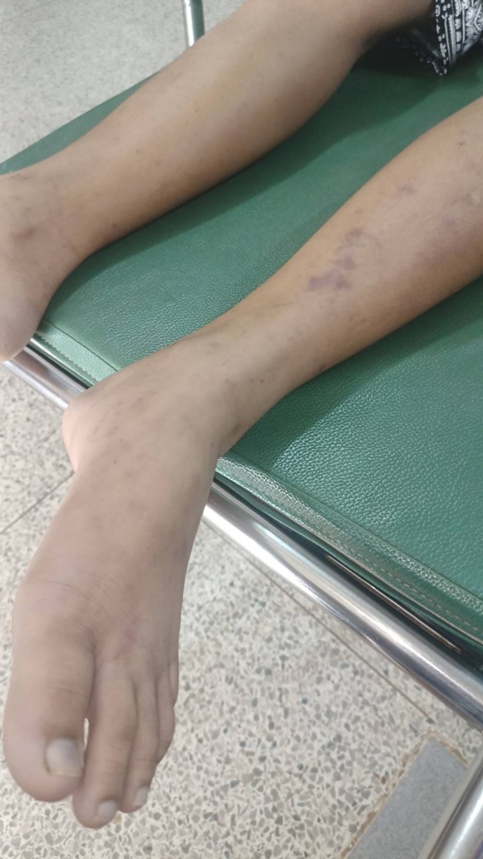 เสียชีวิตหลังเรียนพละ