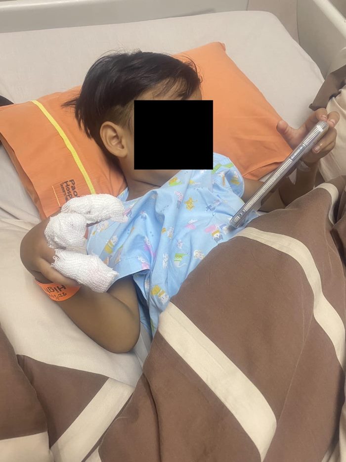 บันไดเลื่อนหนีบนิ้วเด็กขาด