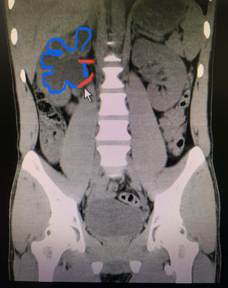 ปวดหลัง