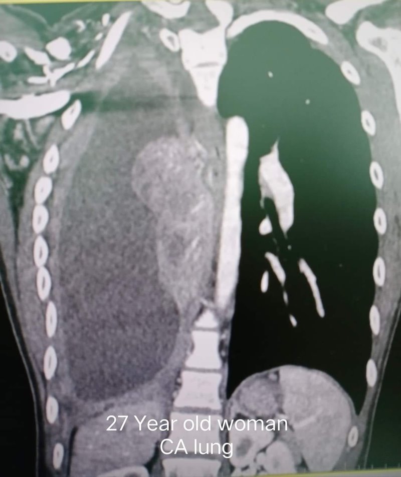 มะเร็งปอด