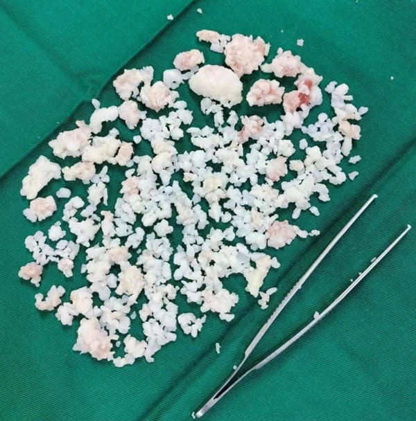 เม็ดในข้อศอก