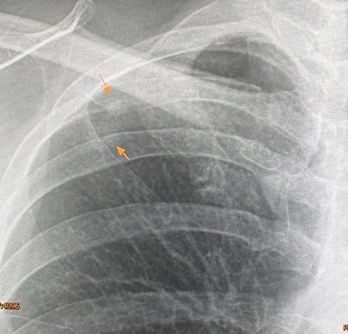 ปอดอักเสบ ติดเชื้อรา