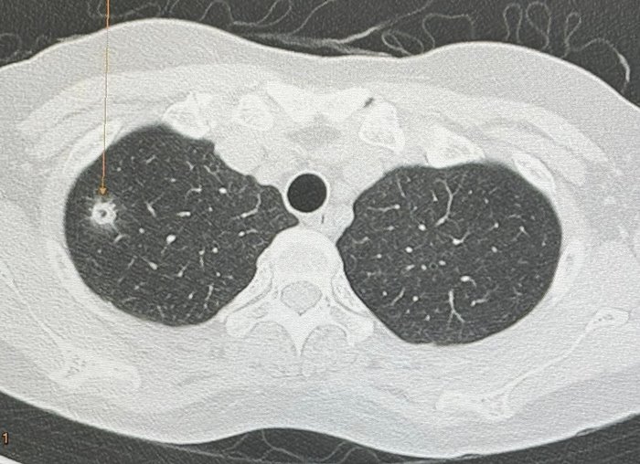 ปอดอักเสบ ติดเชื้อรา