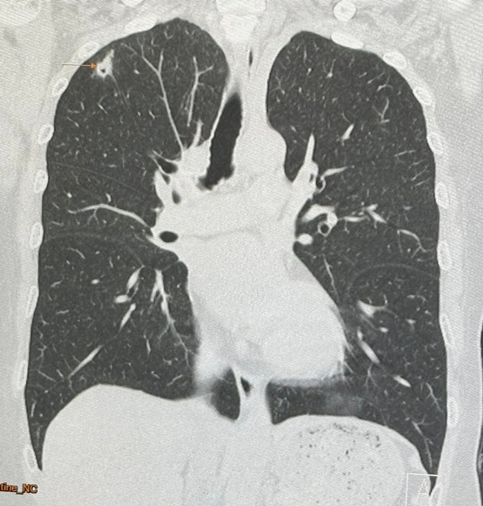 ปอดอักเสบ ติดเชื้อรา