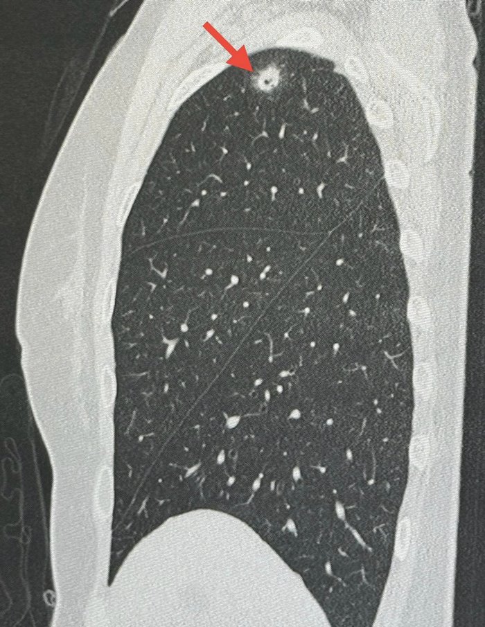 ปอดอักเสบ ติดเชื้อรา